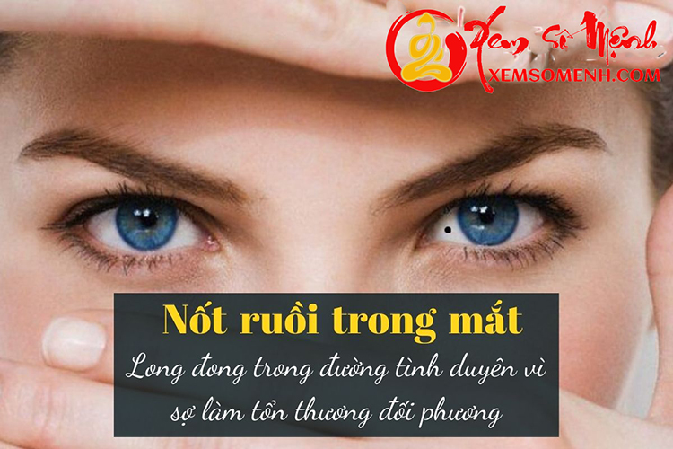 Not ruoi trong mat la not ruoi dao hoa o nu gioi