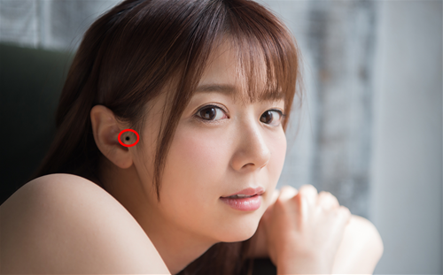 Nốt ruồi ở bình nhĩ Not ruoi o binh nhi