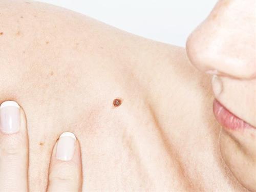 not ruoi tren vai Nốt ruồi trên vai