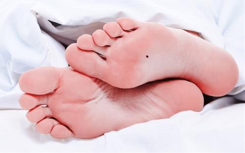 Nốt ruồi ở lòng bàn chân Not ruoi o long ban chan