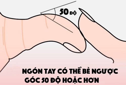 Điều chưa từng công bố về tướng ngón tay cái bẻ ngược hình ảnh 2 Dieu chua tung cong bo ve tuong ngon tay cai be nguoc hinh anh 2
