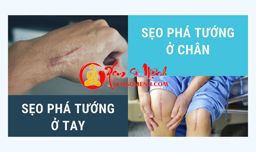 Seo pha tuong o tay, chan