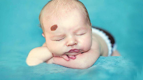 Vết chàm, vết bớt ẩn chứa bí mật gì?