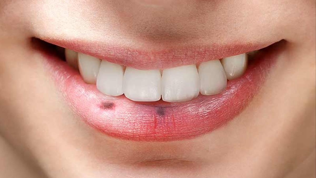 Nốt ở môi và những điều bí ẩn có thể bạn chưa biết