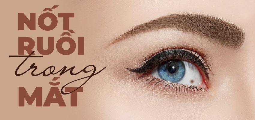 NỐT RUỒI TRONG MẮT CÓ Ý NGHĨA GÌ?
